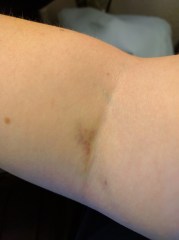 bruises-from-blood-draw