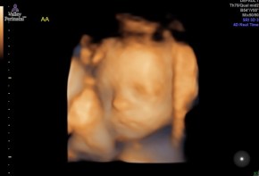 Baby A 3D Ultrasound