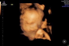 Baby B 3D Ultrasound